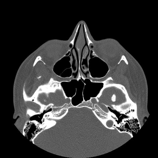 Aneurysmal bone cyst of the mandible (Radiopaedia 43280-46823 Axial bone window 151).jpg