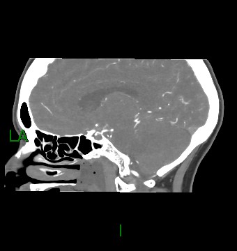 Aneurysmal subarachnoid hemorrhage with intra-axial extension (Radiopaedia 84371-99732 B 30).jpg