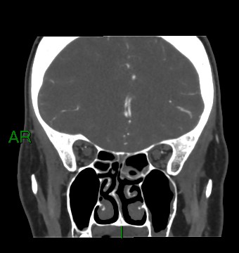 File:Aneurysmal subarachnoid hemorrhage with intra-axial extension (Radiopaedia 84371-99732 C 71).jpg