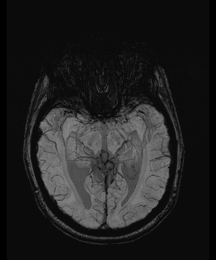 Angiomatous meningioma (Radiopaedia 79459-92579 E 28).jpg