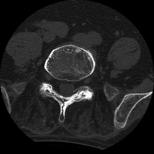 File:Ankylosing spondylitis complicated by fracture-dislocation (Radiopaedia 33583-34674 Axial non-contrast 132).jpg