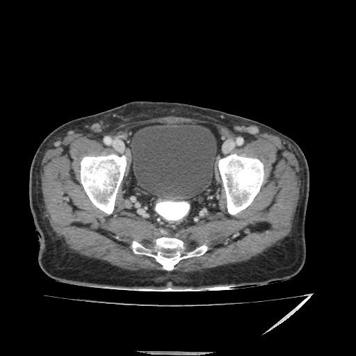 Anorectal carcinoma (Radiopaedia 44413-48064 A 48).jpg