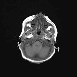 File:Anoxic brain injury (Radiopaedia 79165-92139 Axial T1 5).jpg
