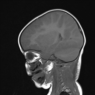 File:Anoxic brain injury (Radiopaedia 79165-92139 Sagittal T1 8).jpg