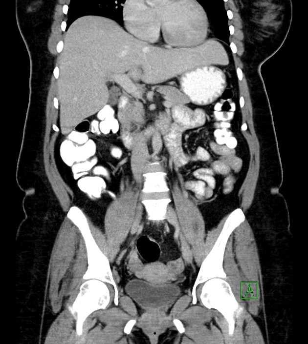 Anterior abdominal wall CSF pseudocyst (CSFoma) (Radiopaedia 79453-92571 B 29).jpg