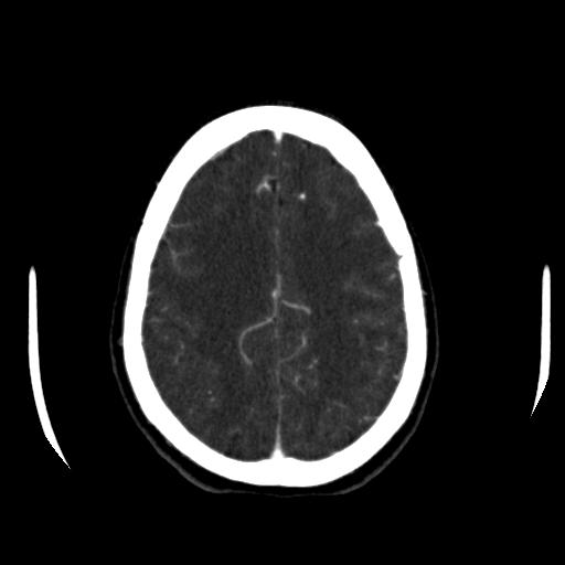 File:Anterior communicating artery aneurysm (Radiopaedia 16633-16335 A 34).jpg