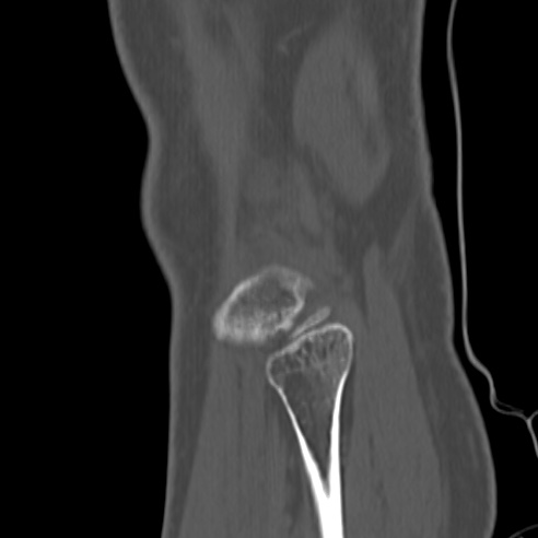 File:Anterior cruciate ligament avulsion fracture (Radiopaedia 58939-66194 Sagittal bone window 2).jpg