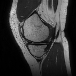 Anterior cruciate ligament rupture and posteromedial corner injury (Radiopaedia 67338-76723 Sagittal PD 46).jpg