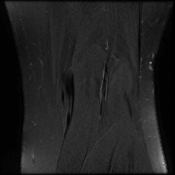 File:Anterior cruciate ligament tear, Wrisberg rip and bucket-handle tear of medial meniscus (Radiopaedia 75872-87266 Coronal PD fat sat 24).jpg
