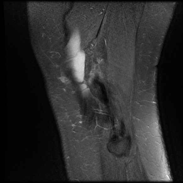 File:Anterior cruciate ligament tear, Wrisberg rip and bucket-handle tear of medial meniscus (Radiopaedia 75872-87266 Sagittal PD fat sat 2).jpg
