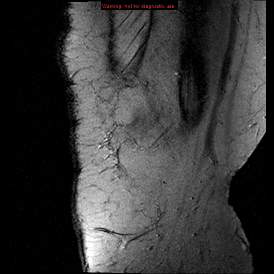 File:Anterior cruciate ligament tear (Radiopaedia 12329-12612 A 22).jpg