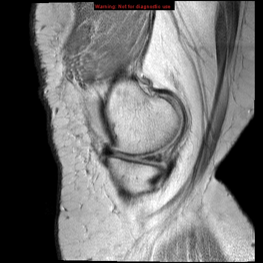 File:Anterior cruciate ligament tear (Radiopaedia 12329-12612 Sagittal T2 fat sat 17).jpg