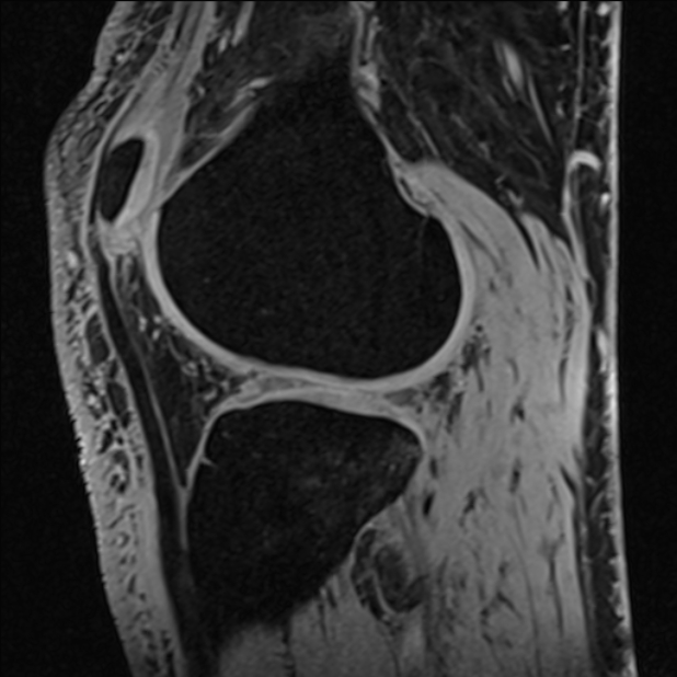 Anterior cruciate ligament tear - ramp lesion (Radiopaedia 71883-82322 Sagittal T1 vibe 46).jpg