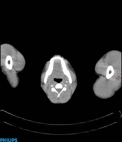 File:Anterior mediastinal seminoma (Radiopaedia 80270-93613 C 5).jpg