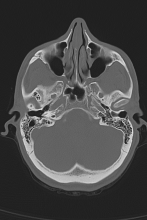 Anterior nasal spine fracture (Radiopaedia 46138-50494 Axial bone window 45).png