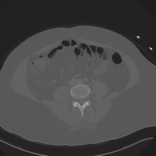 File:Anterior superior iliac spine avulsion fracture (Radiopaedia 44541-48244 Axial bone window 63).png
