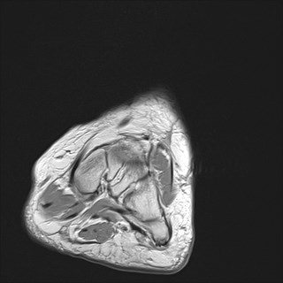 File:Anterior talofibular ligament injury - rupture with soft-tissue impingement (Radiopaedia 38765-40928 Coronal PD 28).jpg