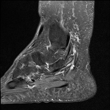 File:Anterior talofibular ligament injury - rupture with soft-tissue impingement (Radiopaedia 38765-40928 Sagittal PD fat sat 5).jpg