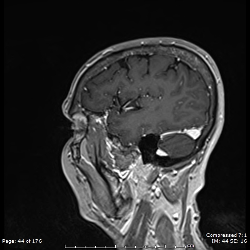 File:Anterior temporal lobe perivascular space (Radiopaedia 88283-104914 Sagittal T1 C+ 5).jpg