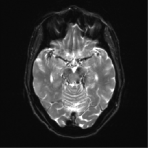 Anterior temporal pole cysts (Radiopaedia 46629-51102 Axial DWI 11).png