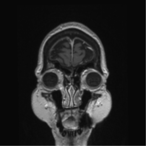 Anterior temporal pole cysts (Radiopaedia 46629-51102 Coronal T1 C+ 159).png
