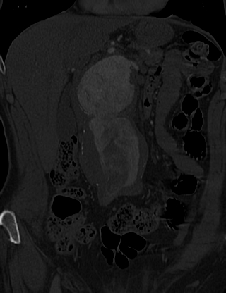 File:Anterior vertebral scalloping (abdominal aortic aneurysm) (Radiopaedia 66744-76067 Coronal bone window 3).jpg