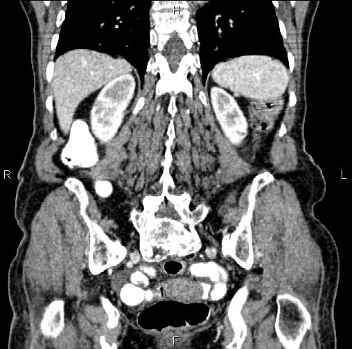 Aortic aneurysm and Lemmel syndrome (Radiopaedia 86499-102554 C 49).jpg
