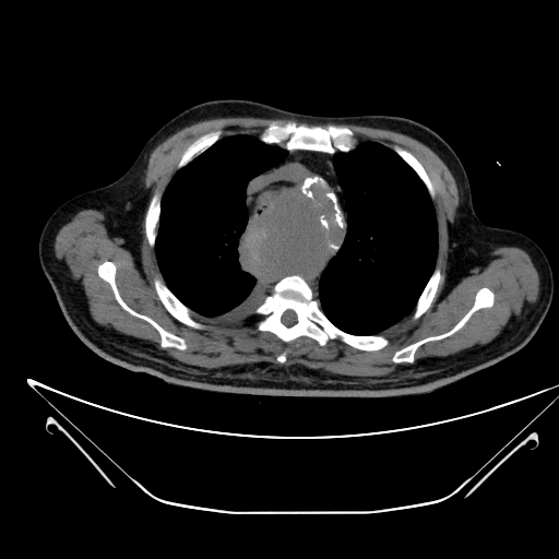 File:Aortic arch aneurysm (Radiopaedia 84109-99365 Axial non-contrast 82).jpg