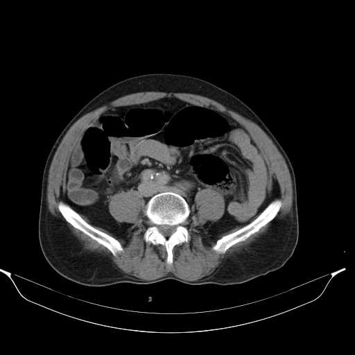 File:Aortic dissection- Stanford type A (Radiopaedia 22085-22085 Axial C+ delayed 34).jpg