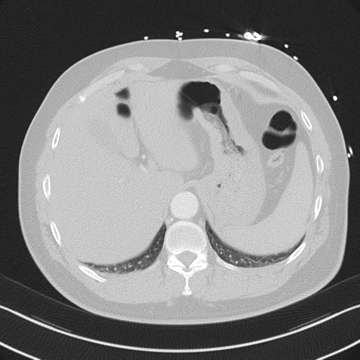 File:Aortic dissection (Radiopaedia 50763-56234 Axial lung window 57).png