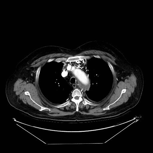 Aortic dissection (Radiopaedia 62562-71000 A 5).jpg