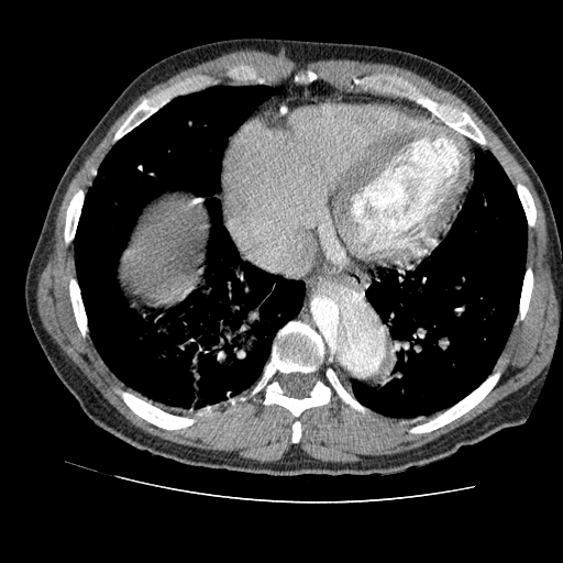 File:Aortic dissection - Stanford A -DeBakey I (Radiopaedia 28339-28587 B 73).jpg