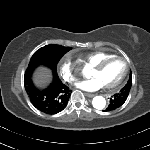 File:Aortic dissection - Stanford type A (Radiopaedia 39073-41259 A 51).png