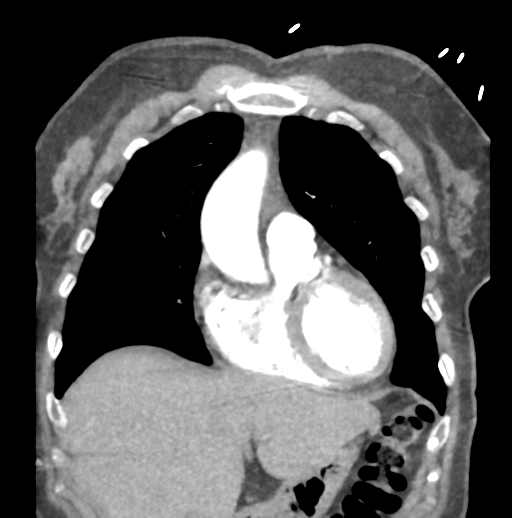 Aortic dissection - Stanford type B (Radiopaedia 50171-55512 B 23).png