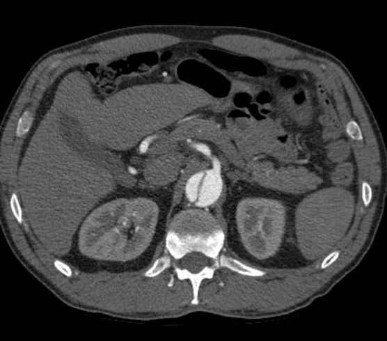 Aortic dissection - Stanford type B (Radiopaedia 73648-84437 A 129).jpg