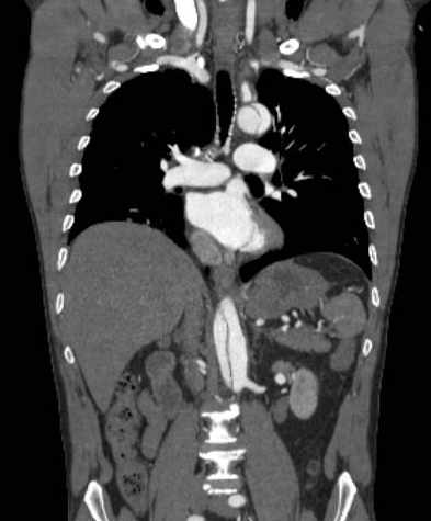 File:Aortic dissection - Stanford type B (Radiopaedia 73648-84437 B 63).jpg