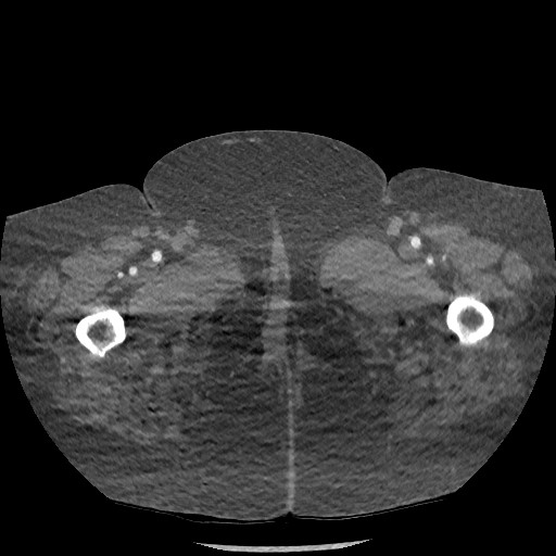 File:Aortic dissection - Stanford type B (Radiopaedia 88281-104910 A 173).jpg