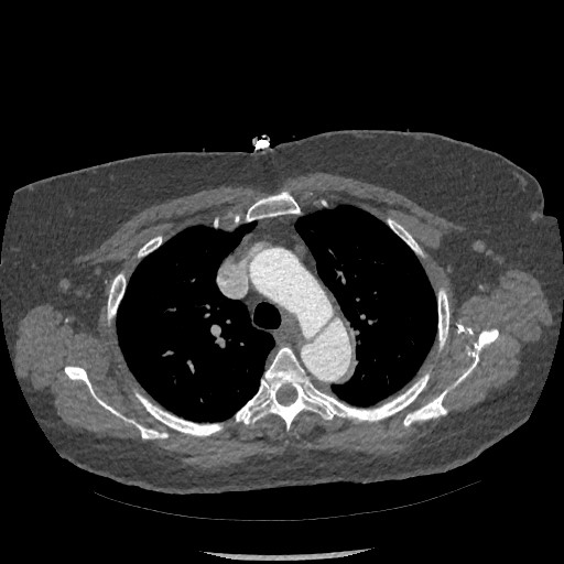 Aortic dissection - Stanford type B (Radiopaedia 88281-104910 A 18).jpg