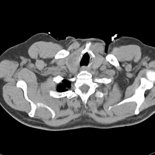 Aortic intramural hematoma (Radiopaedia 31139-31838 Axial non-contrast 4).jpg