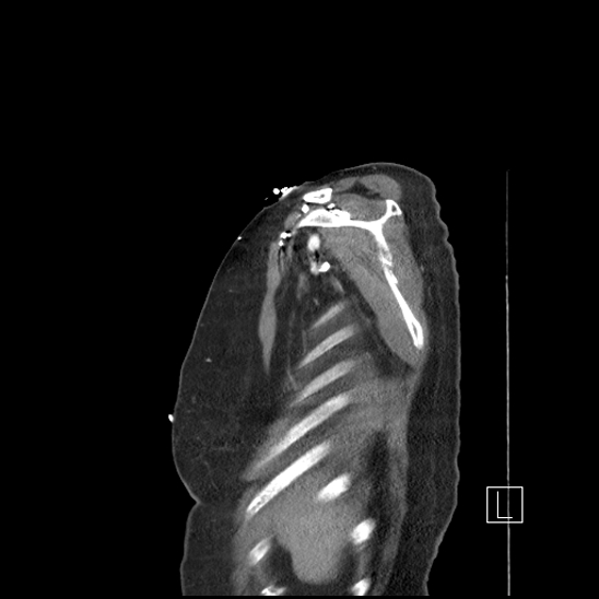 Aortic intramural hematoma with dissection and intramural blood pool (Radiopaedia 77373-89491 D 3).jpg