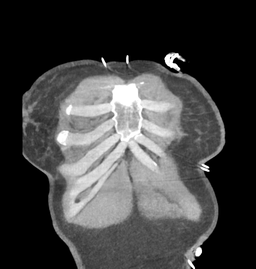 Aortic valve non-coronary cusp thrombus (Radiopaedia 55661-62189 C 9).png
