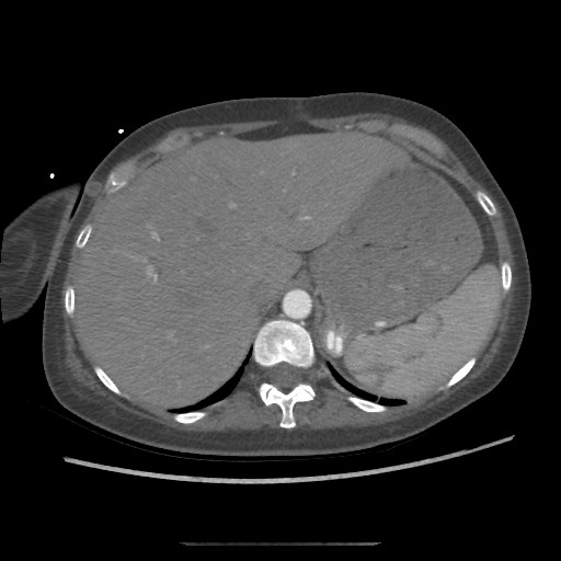 Aorto-duodenal fistula (Radiopaedia 25668-25850 A 10).jpg