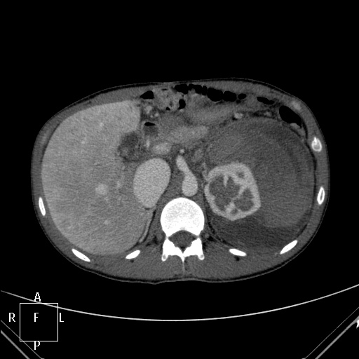 File:Aorto-left renal vein fistula (Radiopaedia 45534-49628 A 8).jpg