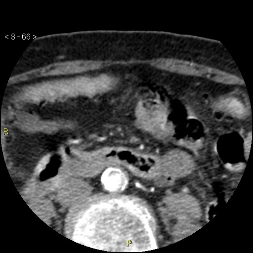 Aortoiliac occlusive disease (Radiopaedia 16828-16548 A 66).jpg