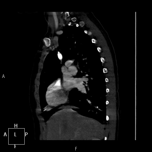 File:Aortopulmonary septal defect (Radiopaedia 41990-45013 Sagittal C+ CTPA 40).jpg
