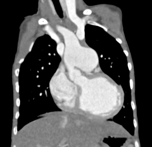 File:Aortopulmonary window, interrupted aortic arch and large PDA giving the descending aorta (Radiopaedia 35573-37074 D 24).jpg