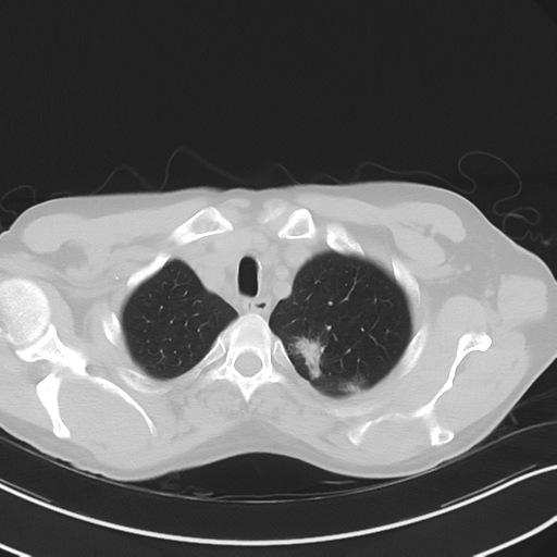 Apical pulmonary metastasis (Radiopaedia 46338-50754 Axial non-contrast 12).png