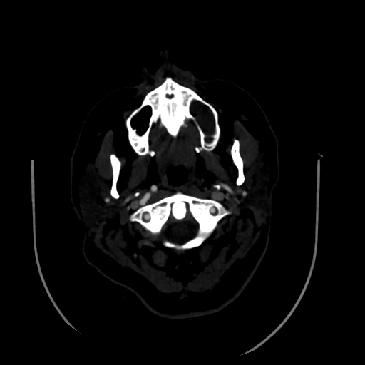 File:Aplasia of the internal carotid artery (Radiopaedia 61082-68960 A 2).jpg