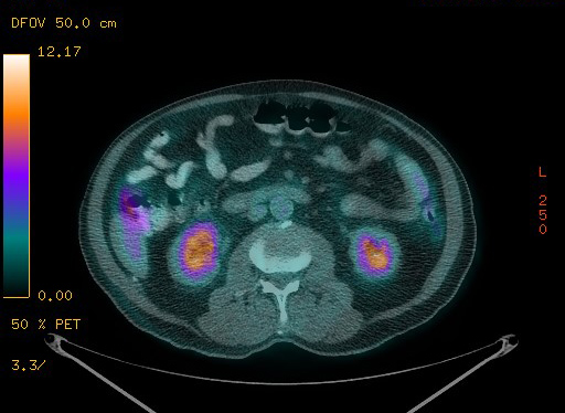 Appendiceal adenocarcinoma complicated by retroperitoneal abscess (Radiopaedia 58007-65041 Axial PET-CT 127).jpg