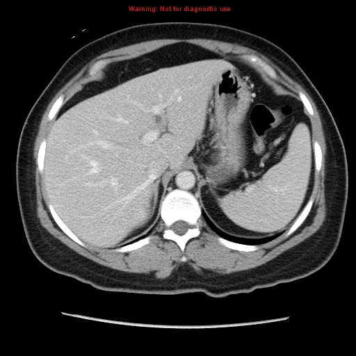 Appendiceal mucinous cystadenoma (Radiopaedia 8263-9111 Axial liver window 22).jpg